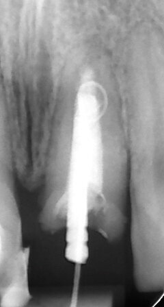 Fig. 2a: (a) Endodontically treated tooth with fistula. (b) After retreatment, the tooth showed an open apex. (c) MTA application with the MAP System and PD MTA White. Condensation of the MTA with pluggers (d) or paper points (e). (f) MTA plug. (g) Post-op radiograph showing the MTA plug and the reconstruction with a fibre post.
