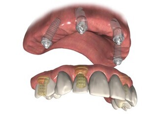 DIEM 2: Solutions for immediate full arch rehabilitation DIEM 2: Solutions for immediate full arch rehabilitation