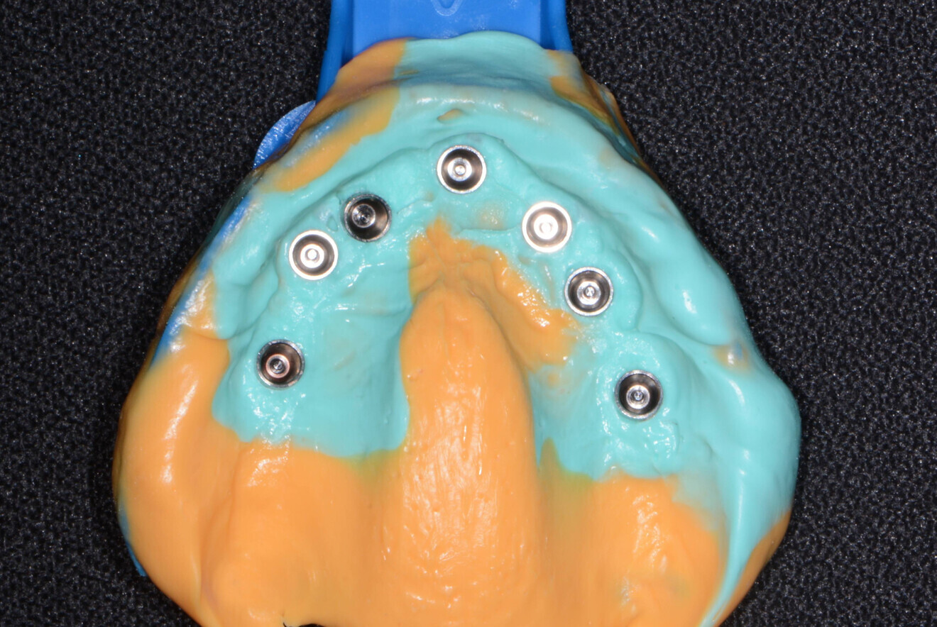 Fig. 14: Open-tray impression.