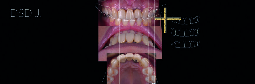 Fig. 5 : DSD définitive (vue de face, vue du dessus et vue occlusale). 