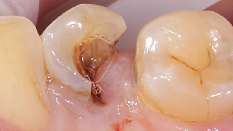 Fig. 1. Situación inicial: el diente 34 estaba fuertemente dañado. La encía se había adentrado en la cavidad.