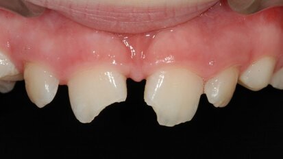 Epidemiologia e approcci innovativi nei traumi dentali (una branca piuttosto trascurata dell’odontoiatria)