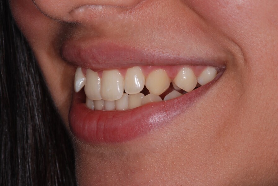 Fig. 9: Smile left side view before treatment.