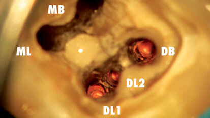 Dentální operační mikroskop v endodoncii