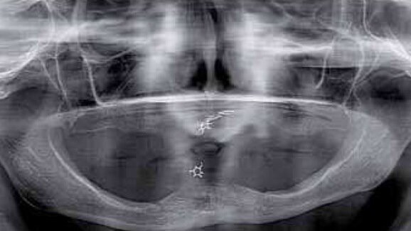 Rehabilitacja implantoprotetyczna w silnej atrofii wyrostka zębodołowego w zespole Kellego