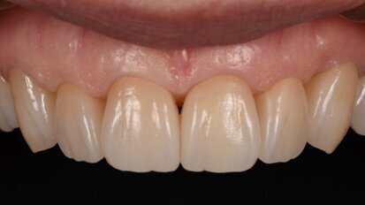 One step closer to nature: Occlusal concepts and sophisticated aesthetics in digital dentistry