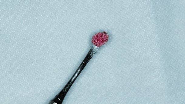 Cellules souches en implantologie