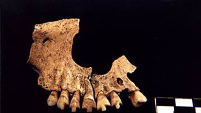 Βρέθηκε οδοντική έμφραξη από τη λίθινη εποχή