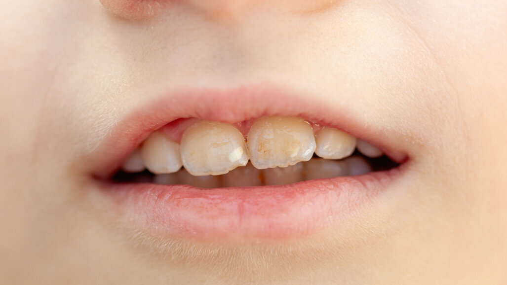 One in seven 12-year-olds in Germany suffer from MIH