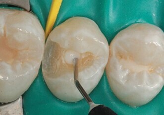 Ca-Lok Flowable Adhesive Calcium Base/Liner