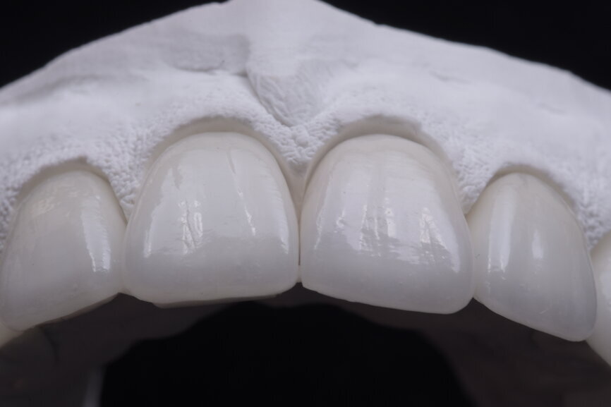 Fig. 76: Glazed ceramic veneers on the plaster model.