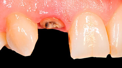 Risoluzione morfologico-estetica di un incisivo laterale: approccio mini-invasivo