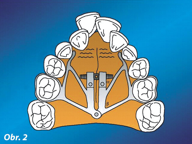 Grafické znázornění rychlého „pavoučího“ expandéru (Cozza et al., 2001)