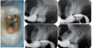Webinar to showcase how to arrive at the correct working length