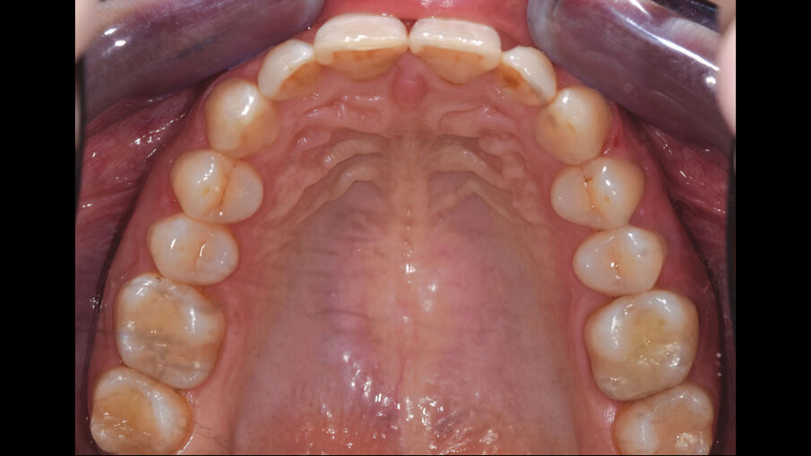 Figg. 8g, 8h_Foto occlusali di fine trattamento.