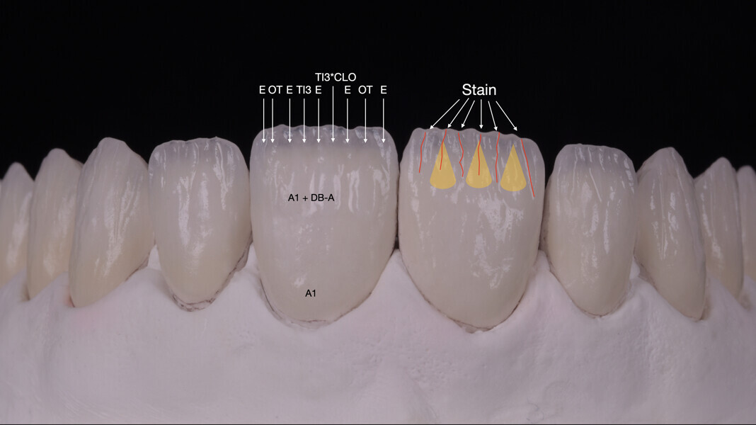 Fig. 11b: ... and details of the ceramic layering. E = enamel; OT = translucent opal; TI3 = violet translucent; CLO = transparent; A1 = dentine Shade A1; DB-A = bleached dentine Shade A.