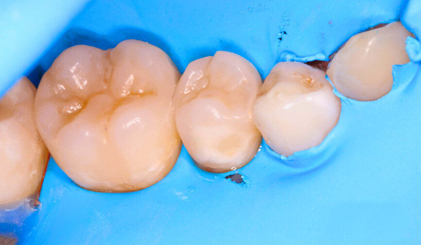 Fig. 10: Dr Aleksandra Łyżwińska’s protocol for achieving a mirror-like gloss polish involves the use of high-quality diamond rubber spirals with gradation, used with sensitivity over an extended period. 