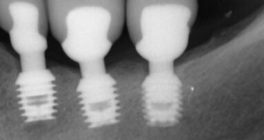 Gli impianti corti: un’opzione di successo nei trattamenti a breve termine