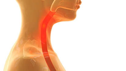 Verschluckte Prothese blockiert Speiseröhre