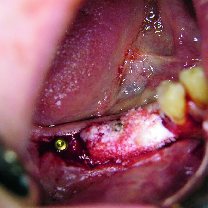 Fig. 3: 3-D modelling of NanoBone.