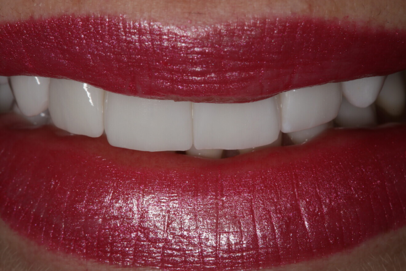 Fig. 24: Superior view of the smile, showing the facial surface texture of the denitive restorations and how nicely they followed the lower lip.