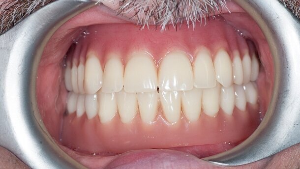 Rehabilitacja protetyczna z zastosowaniem protezy całkowitej wspartej o implant – opis przypadku