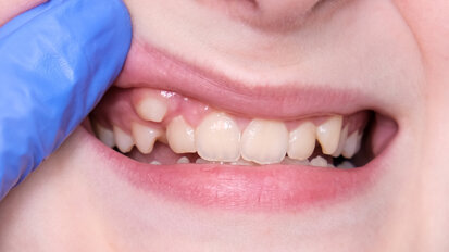 LightForce Orthodontics secures funding for 3D‑printed brackets