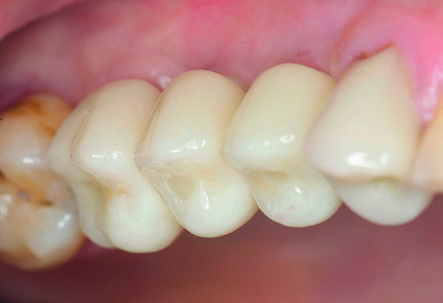 Fig. 24 : Vue latérale des couronnes insérées sur les implants. 
