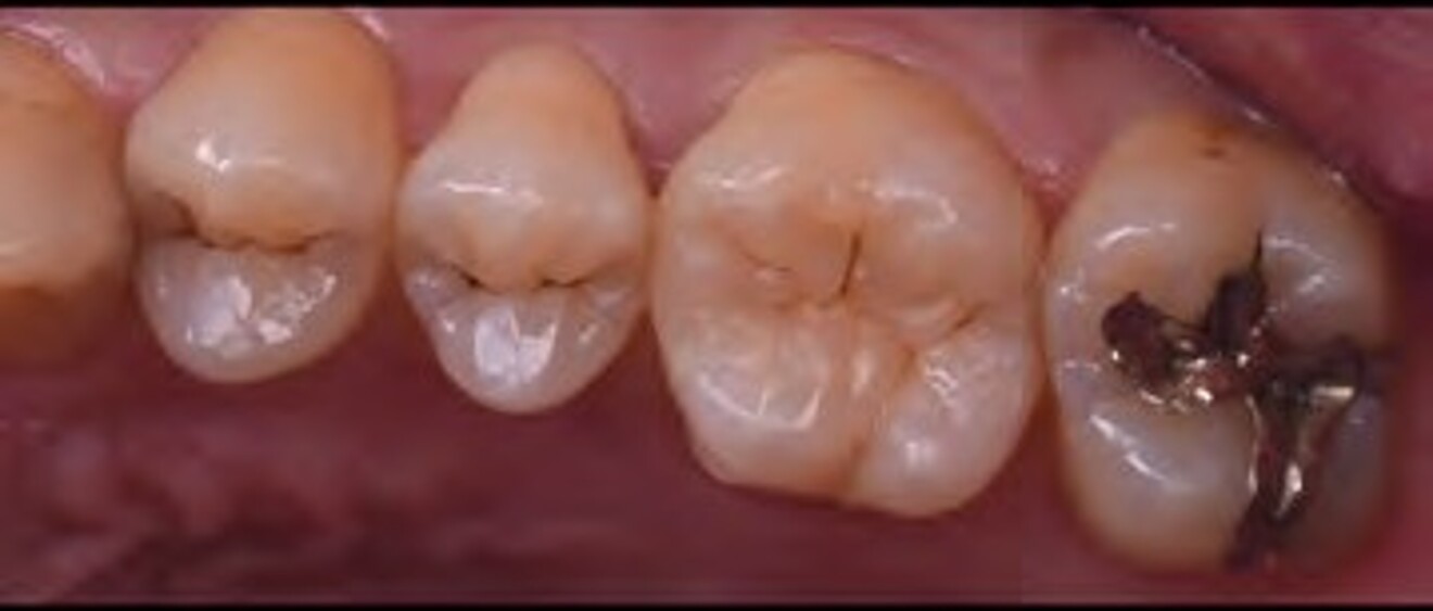  Fig. 3c: Oblique postoperative view highlighting the natural occlusal anatomy and seamless marginal adaptation of the restorations. 