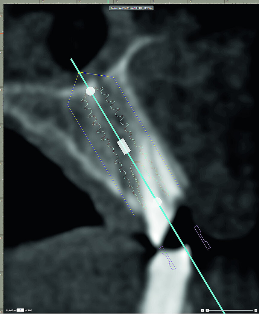 Fig. 3: Cross-sectional slice revealing the trajectory of the maxillary alveolus vs the trajectory of the root when planning for an implant.