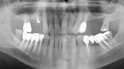 Apport des technologies numériques et de la CFAO en prothèse implantaire vissée : deux cas cliniques
