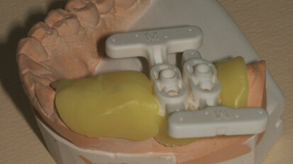 Intégration de la CFAO globale au quotidien : implantologie guidée par CEREC Guide et couronne usinée sur TiBase