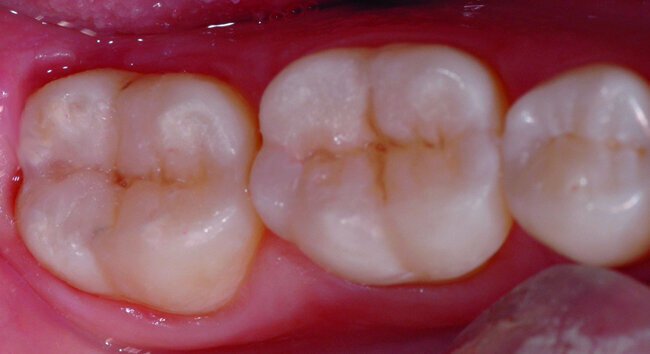 Fig. 35 : Après dépose du champ opératoire il faut s’assurer que l’occlusion ne soit pas perturbée par la procédure de re-étanchéification.