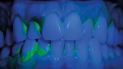 Lo sbiancamento professionale, forza trainante nella concordance sul miglioramento del controllo del biofilm batterico domiciliare