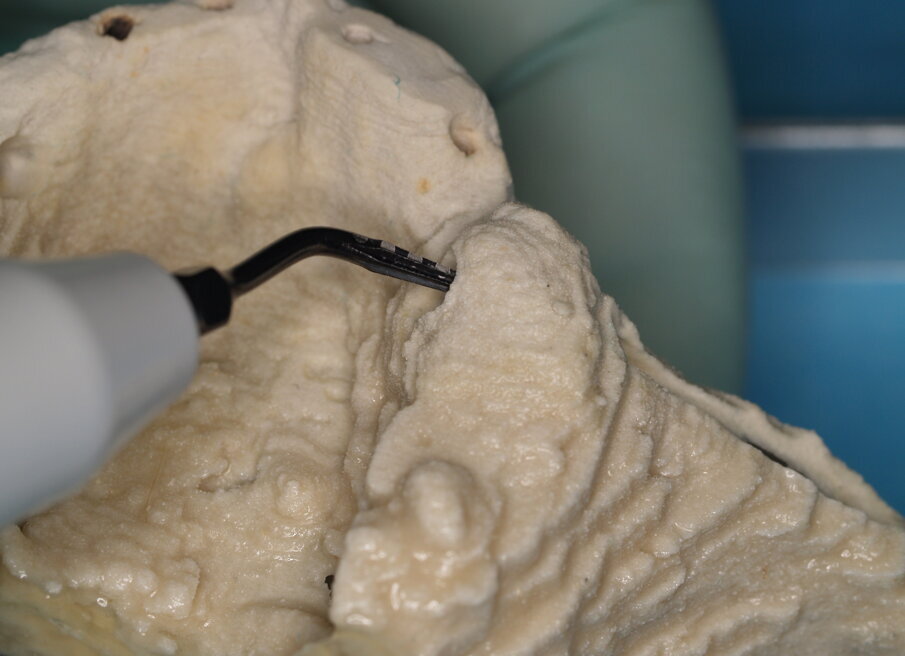 Figg. 6, 7 - Con l’inserto ES007T è possibile smussare gli angoli della preparazione.