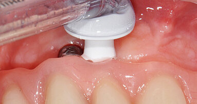„Prevence 0“: nejúčinnější prevence periimplantitidy?