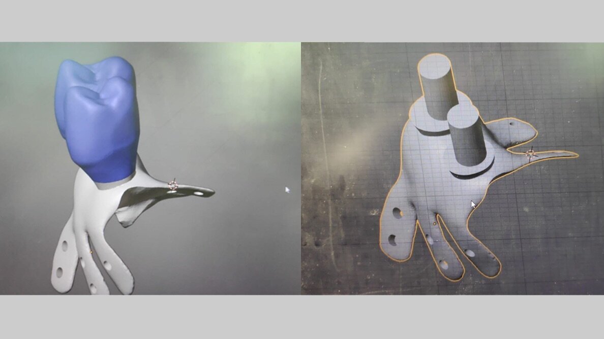 Cierre de comunicación oro-sinusal con placa de titanio personalizada 3D