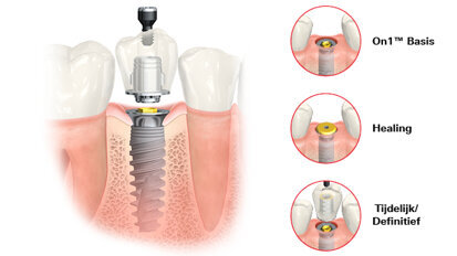On1™ combineert het beste van twee werelden.