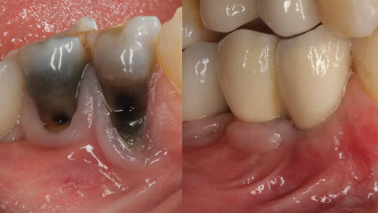 A surgical approach to the management of periapical implant lesions