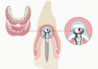 Atlas for Denture Comfort Implant System
