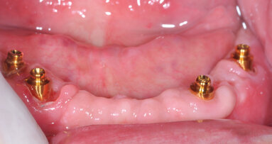 Protesi superiore e inferiore su componentistica Rhein83