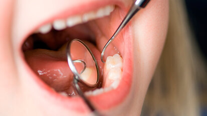 Con la crisi è boom di carie tra i bambini (+15%) (e sta crescendo anche tra i 25enni)