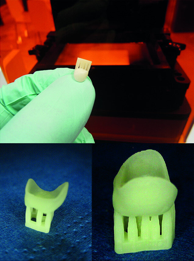 Fig. 5: 3D printing of the temporary crown with E-Dent 400—
biocompatible, CE-certified Class IIa (described as generally invasive products with a short-term application, validated up to one year in the mouth by the manufacturer) and 3D printed support structure.