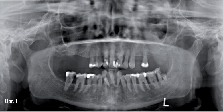 Výchozí situace na rentgenovém snímku