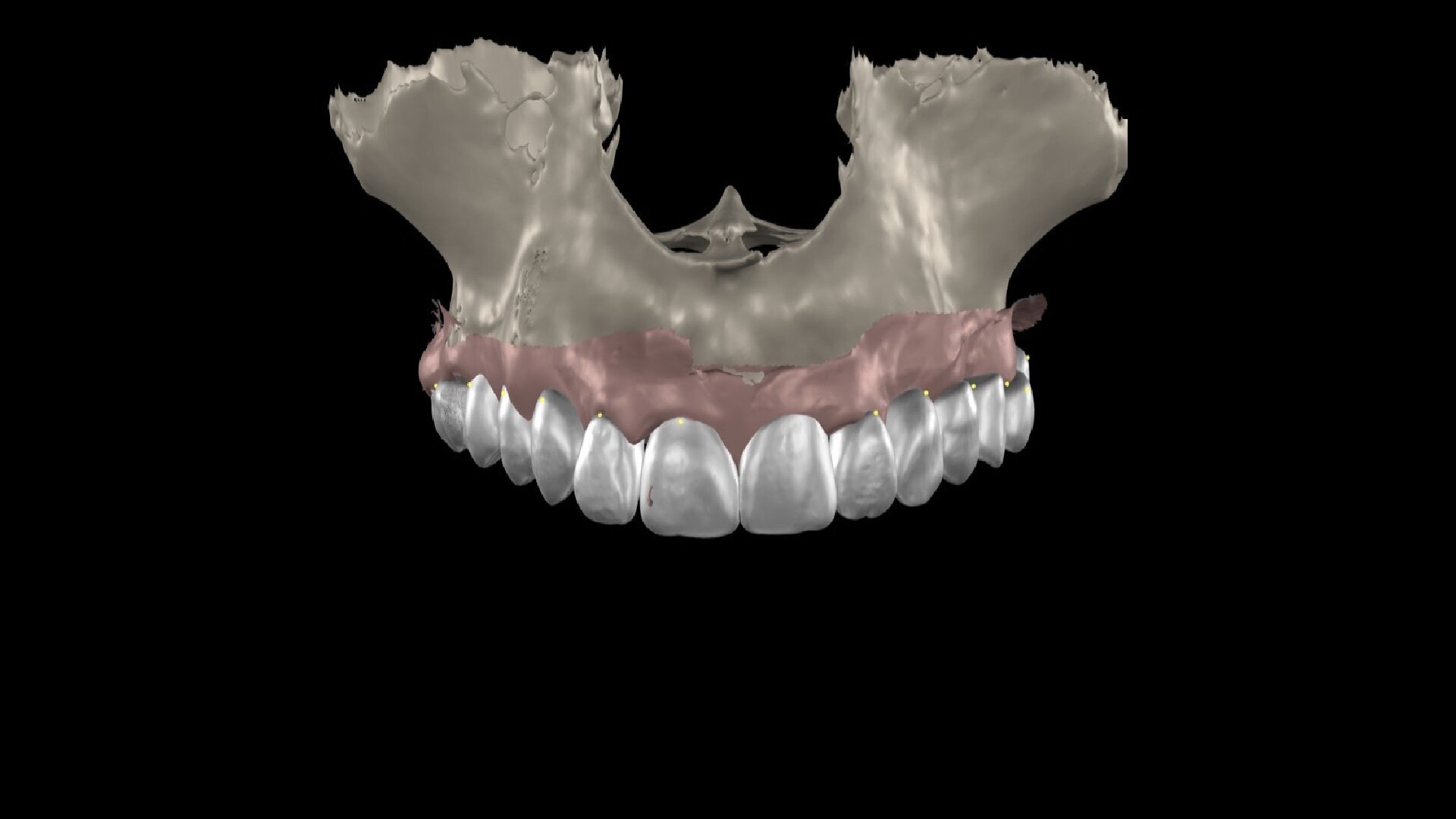 Transforming full-mouth rehabilitation: A case report on Smilecloud and digital workflows