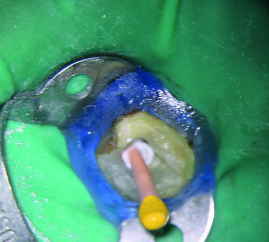 Fig. 14 : Obturation avec un ciment de scellement biocéramique. 
