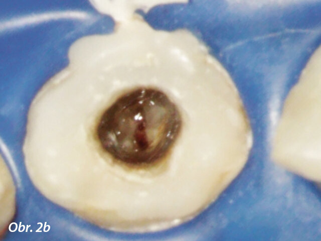 Po reendodoncii se ukázal otevřený apex