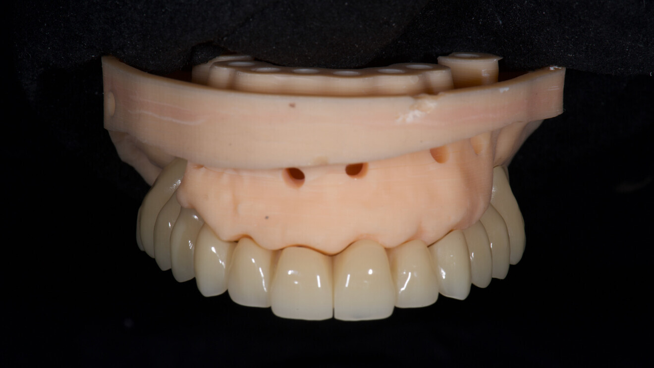 Fig. 5: Prefabricated temporary prosthesis made of PMMA.