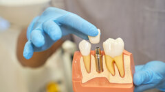 Geistlich webinar to explore AI and precision approaches in implant dentistry