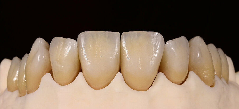 Fig. 14: The final restoration (IPS d.SIGN) after the second corrective firing cycle